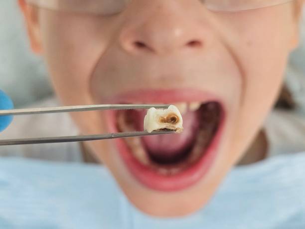 Best Emergency Tooth Extraction in Telford, PA